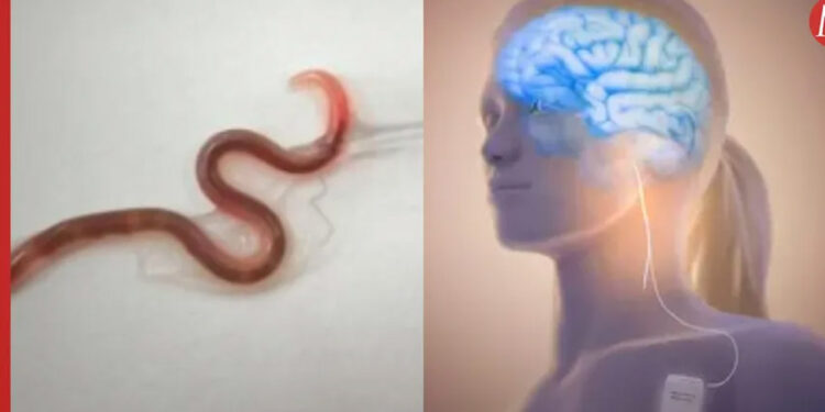 Extraen lombriz intestinal VIVA de 8 centímetros del cerebro de mujer australiana