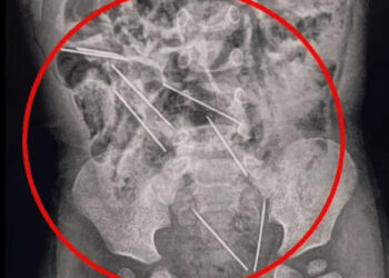 Bebé de 2 años se traga agujas para inyectar vacas y logra sobrevivir en Perú