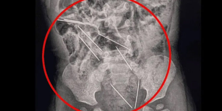 Bebé de 2 años se traga agujas para inyectar vacas y logra sobrevivir en Perú