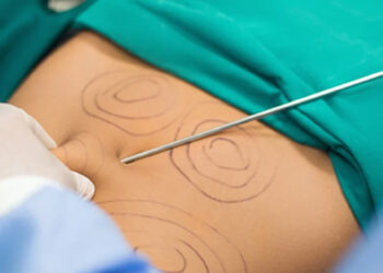 Mujer está grave tras realizarse una lipotransferencia