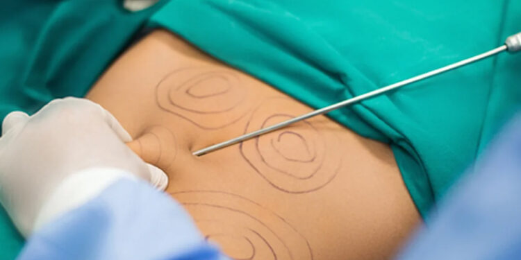 Mujer está grave tras realizarse una lipotransferencia