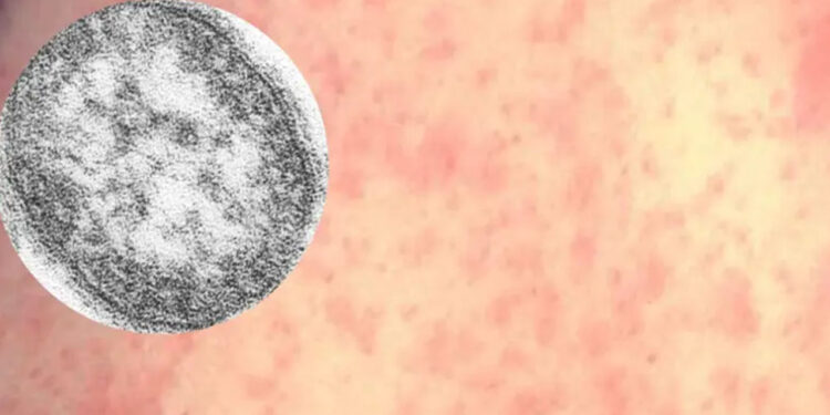 ¿Cómo se contagia el sarampión y cuáles son sus síntomas?