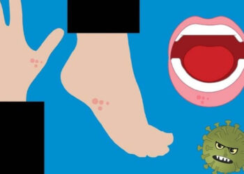 ¿Cómo se contagia el virus coxsackie?, padecimiento que ha puesto en alerta a las guarderías de Hidalgo