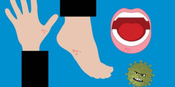 ¿Cómo se contagia el virus coxsackie?, padecimiento que ha puesto en alerta a las guarderías de Hidalgo