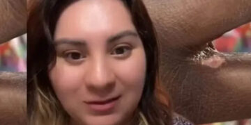 Funcionaria de casilla denuncia haber sufrido quemadura por tinta indeleble