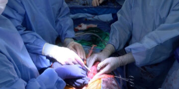 Murió la mujer que recibió un trasplante de riñón de un cerdo