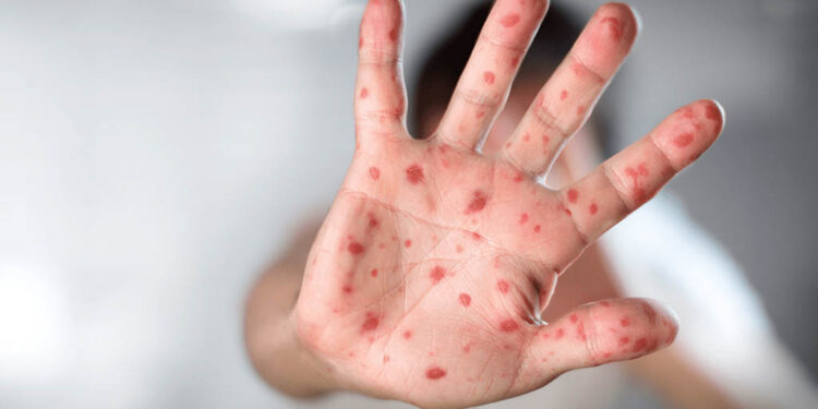 Tlaxcala reporta su primer caso de viruela del mono de 2024