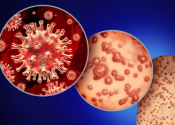 Se confirma el primer caso de viruela del mono en Sinaloa