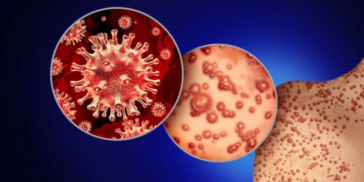 Se confirma el primer caso de viruela del mono en Sinaloa