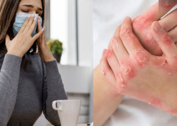 Virus mpox vs. COVID-19: ¿Qué enfermedad es más peligrosa y por qué?