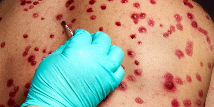 OMS: La viruela del mono “no es el nuevo covid, sabemos enfrentarlo”