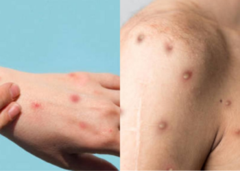¿Cuáles son los síntomas de mpox y qué diferencia hay entre las cepas de Mpox?