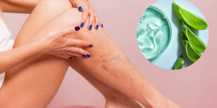 La hierba medicinal que alivia la inflamación de las várices y cuida la salud de las piernas