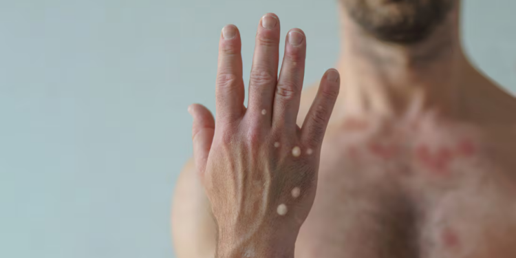 Primer caso de Mpox en Nayarit genera alerta; paciente se retira de hospital en transporte público sin haber hecho cuarentena