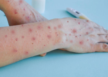 Confirman dos casos importados de Mpox en Sonora