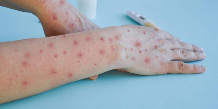 Confirman dos casos importados de Mpox en Sonora