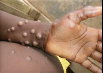 Registra SSA en Sinaloa un nuevo caso por viruela mono