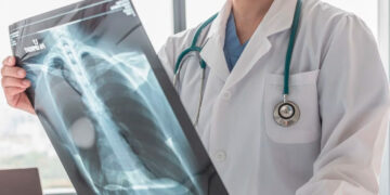 ¿Qué estudios te debes de hacer para prevenir el cáncer de pulmón?