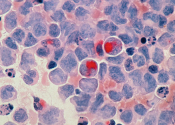 Huellas moleculares pueden mejorar detección precoz del cáncer