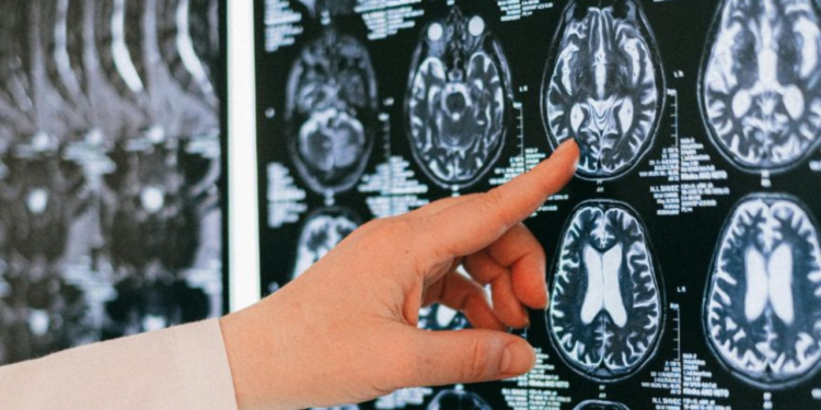 Científicos descubren una proteína capaz de detener el envejecimiento cerebral