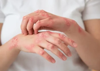 ¿Te salen ronchas cuando sube la temperatura? Descubre qué es la urticaria por calor y cómo evitarla