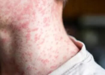 Alerta por muertes de niños por sarampión: así es como se contagia la enfermedad y síntomas