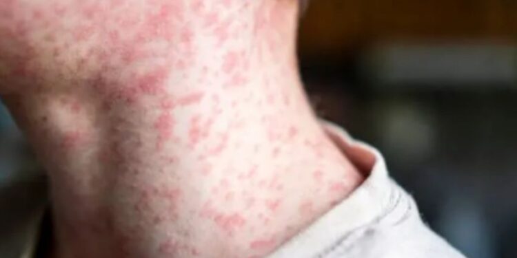 Alerta por muertes de niños por sarampión: así es como se contagia la enfermedad y síntomas