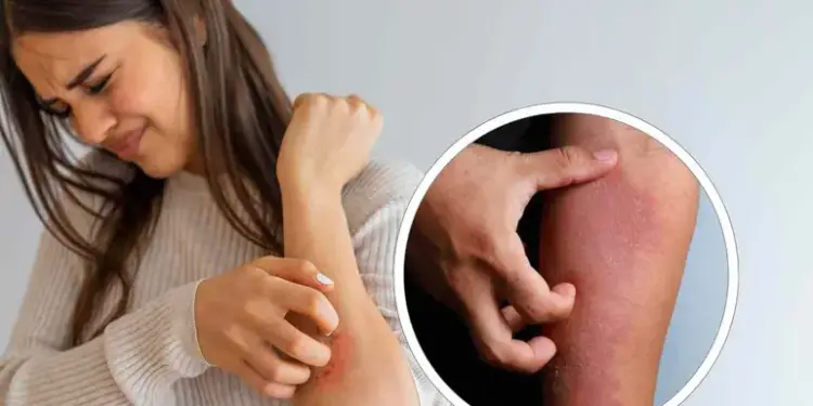 ¿Qué es exactamente la dermatitis atópica? Cómo identificarla y aprender a controlarla