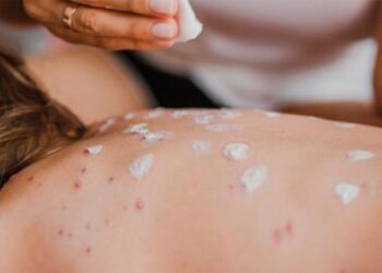 Suman 2 mil 400 casos de sarampión; México ocupa el segundo lugar en las Américas