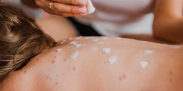 Suman 2 mil 400 casos de sarampión; México ocupa el segundo lugar en las Américas