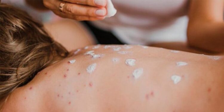 Suman 2 mil 400 casos de sarampión; México ocupa el segundo lugar en las Américas