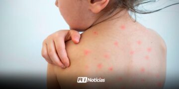 En Sinaloa brote de sarampión suma 12 casos; anuncian mega jornada de vacunación en Juan José Ríos