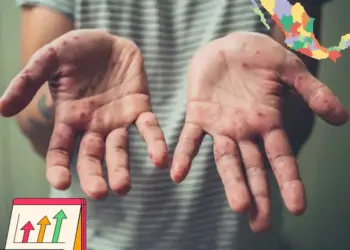 ¿Cuántos casos de sarampión hay en México? Estos son los estados que registraron muertes