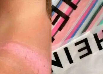 Del look soñado al dolor extremo, joven sufre quemaduras por usar ropa de Shein en vacaciones