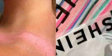 Del look soñado al dolor extremo, joven sufre quemaduras por usar ropa de Shein en vacaciones