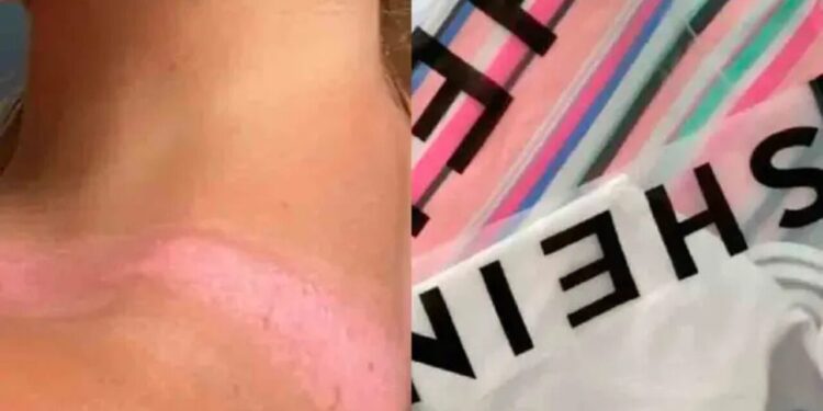 Del look soñado al dolor extremo, joven sufre quemaduras por usar ropa de Shein en vacaciones