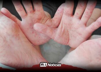 Sinaloa reporta cerca de 50 casos de virus Coxsackie; autoridades llaman a la calma y la prevención