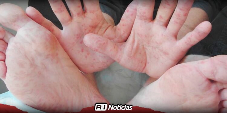 Sinaloa reporta cerca de 50 casos de virus Coxsackie; autoridades llaman a la calma y la prevención