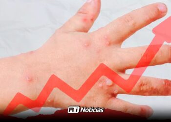 Virus Coxsackie registra cerca de 60 en Sinaloa: Los más afectados son niños de 5 años