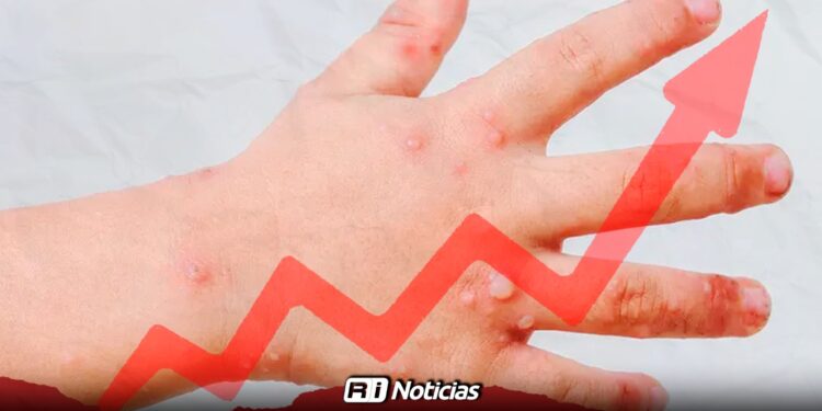 Virus Coxsackie registra cerca de 60 en Sinaloa: Los más afectados son niños de 5 años