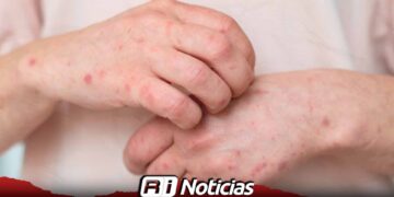 México acumula 24 muertes y casi seis mil casos de sarampión