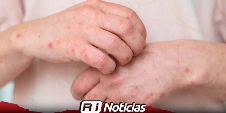 México acumula 24 muertes y casi seis mil casos de sarampión