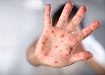 México registra un aumento de casos de sarampión; enciende alertas sanitarias