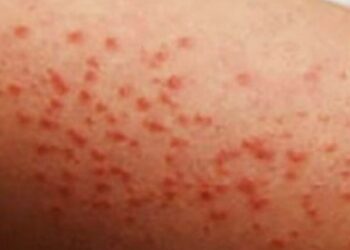 Sarampión se expande por todo México; Piden vacunarse