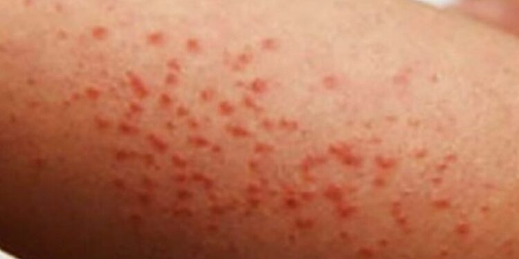 Sarampión se expande por todo México; Piden vacunarse