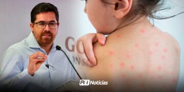 Sinaloa registra 72 casos de sarampión en el año