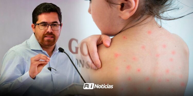 Sinaloa registra 72 casos de sarampión en el año