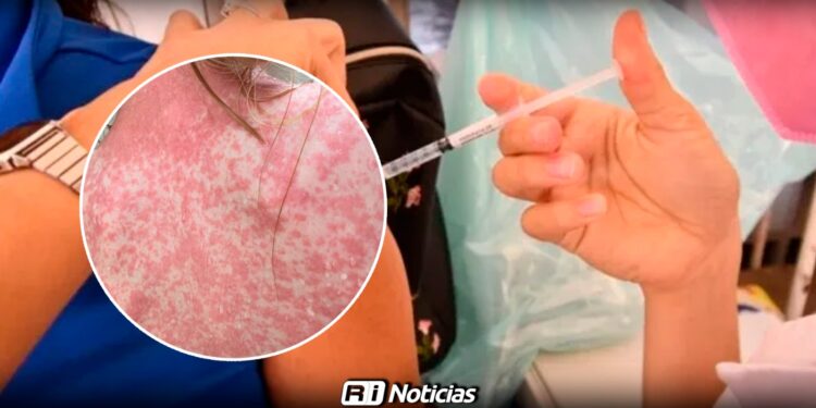 Confirman 33 casos de sarampión en Villa Unión; refuerzan brigadas de vacunación