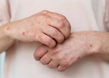 Sarampión en México: Salud confirma la primera muerte en 2026