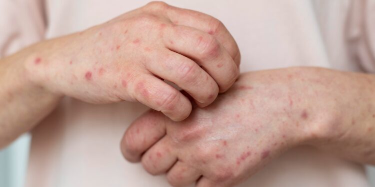 Sarampión en México: Salud confirma la primera muerte en 2026